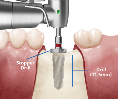 Osstem TS implantát s optimalizovanou mikroštruktúrou povrchu