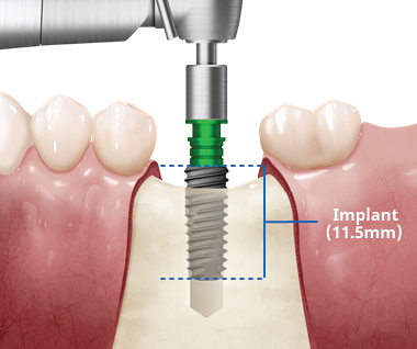 TS implantát pre jednoduchý chirurgický postup