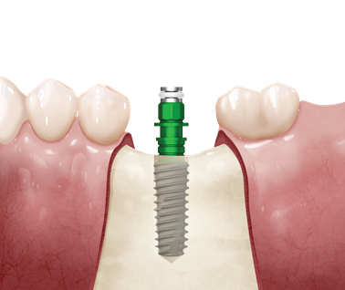 dentálny implantát TS vhodný pre mäkkú aj tvrdú kosť