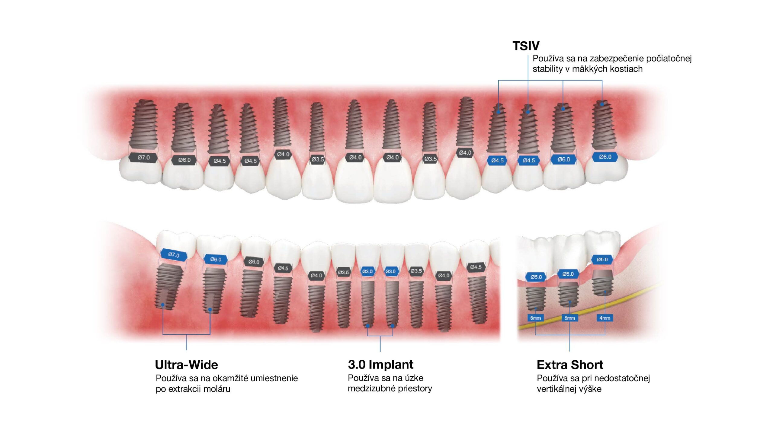 Osstem TS implantát vhodný pre rôzne klinické indikácie