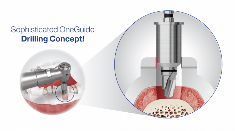 OneGuide Kit chirurgická sada pre guided surgery