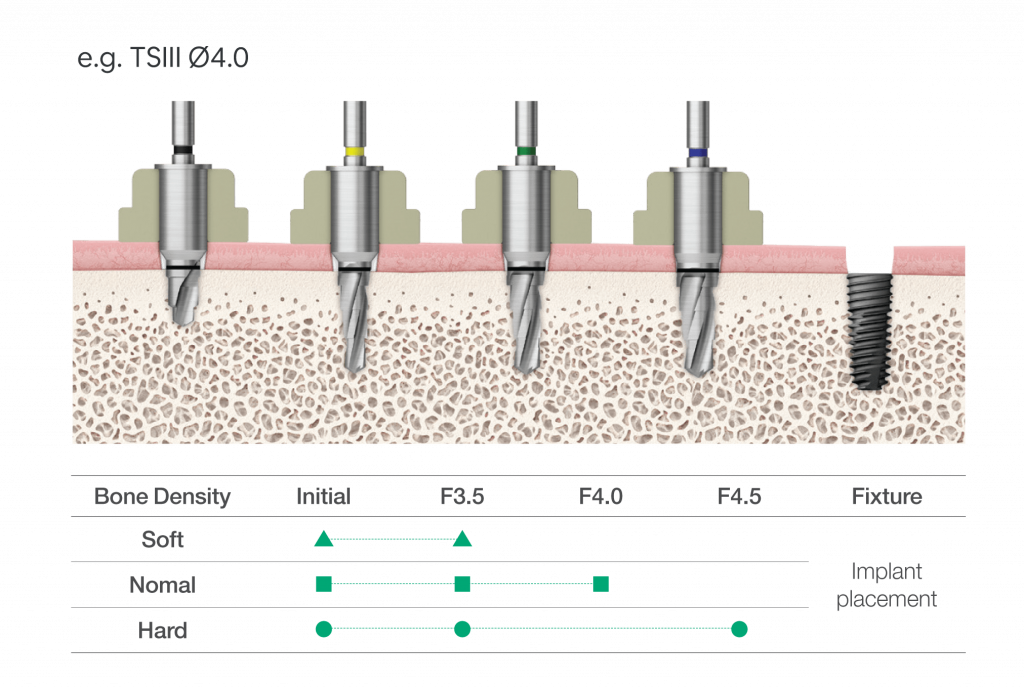 OneGuide Kit presné vedenie vrtáka implantológia