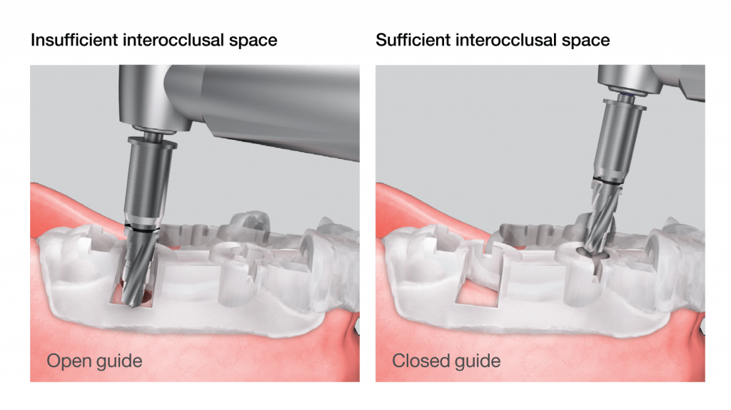 Osstem OneGuide Kit open guide systém implantológia