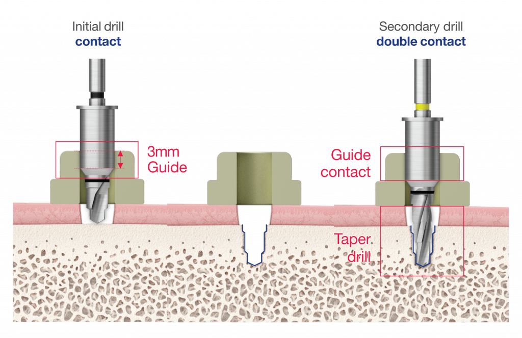 OneGuide Kit rýchla implantácia bez prehrievania
