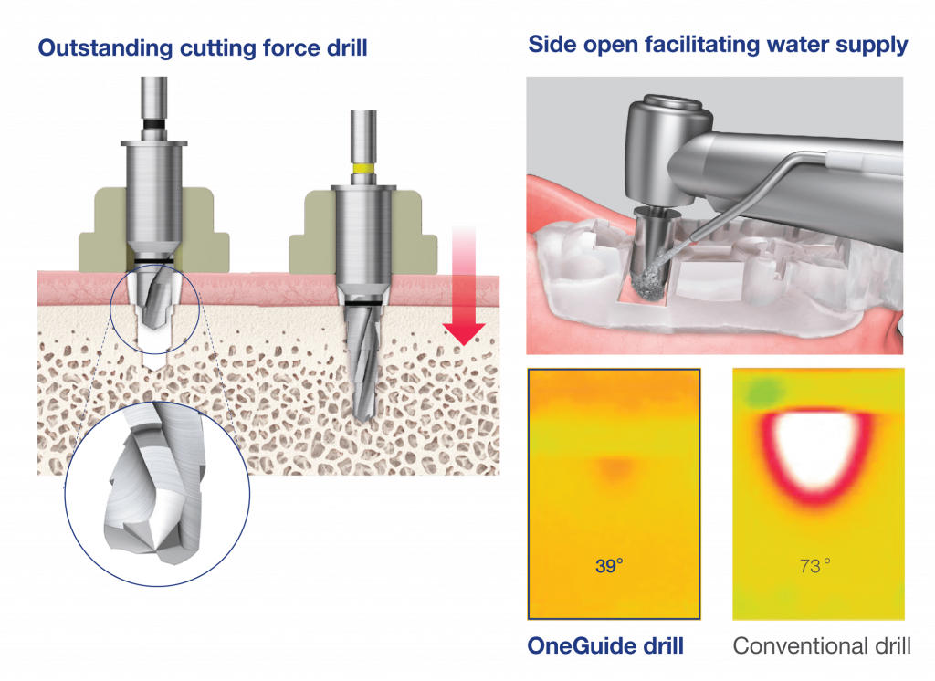 OneGuide Kit digitálne plánovanie implantátov