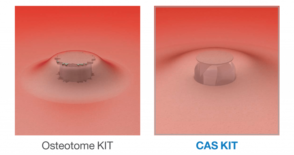 CAS Kit vrtáky so stopper systémom pre sinus lift