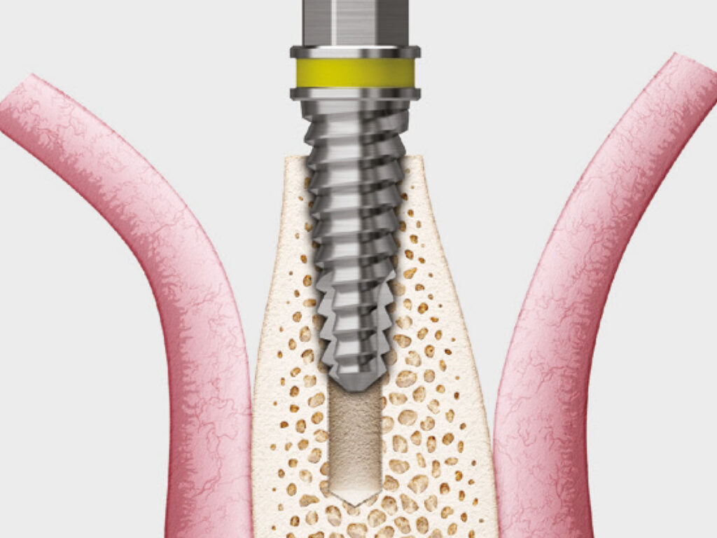 Osstem ESSET Kit pre implantáty v úzkej kosti