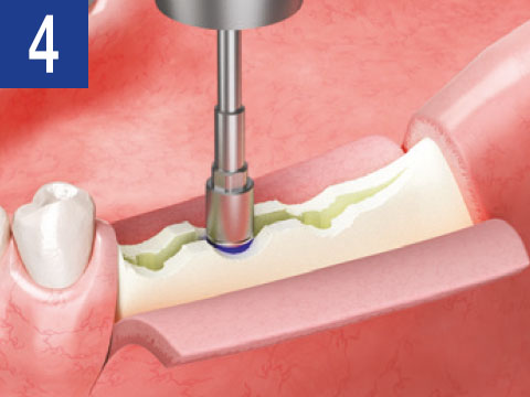 ESSET Kit nástroje pre expanziu kosti implantológia