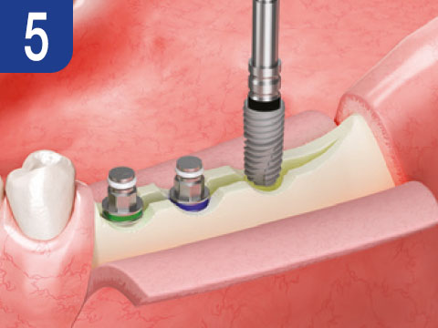 ESSET Kit ridge split bez kladiva implantológia