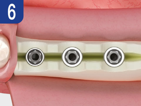Osstem ESSET Kit pre stabilnú implantáciu