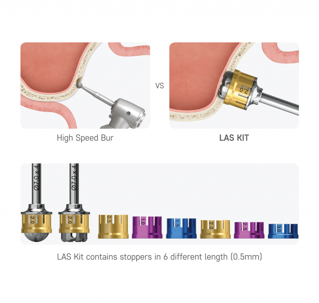 LAS Kit core drill tvorba bone lid sinus lift